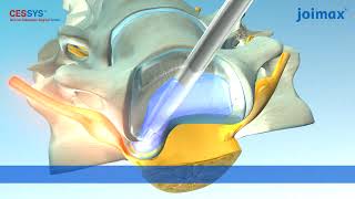 CESSYS®  Cervical Endoscopic Surgery System [upl. by Aikahc808]