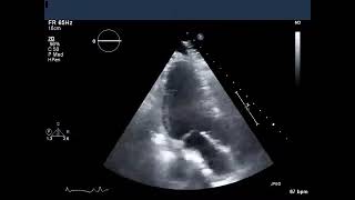 Transthoracic Echocardiogram Showing Basal Inferolateral Wall Motion Abnormality [upl. by Alrats]