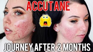 MY ACCUTANE JOURNEY 2 MONTH UPDATE Before amp After Side Effects Skin Care Products Im using [upl. by Tavy]