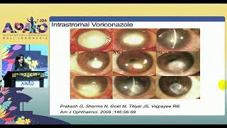 Fungal keratitis [upl. by Ragse]