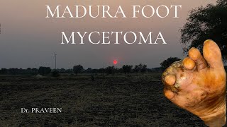 MADURA FOOT  MYCETOMA  ACTINOMYCETOMA  EUMYCETOMA [upl. by Maharba]