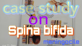 Case study on Spina bifida meningocile pediatric Case plan on Spina bifida meningocile ncp [upl. by Ahset]