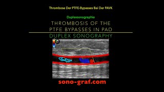 Duplexsonographie  Thrombose Des Bypasses Bei Der Peripheren Arteriellen Verschlusskrankheit [upl. by Giarla]