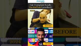 🧑Hair Transplant Results Harshal Patel [upl. by Bluh]