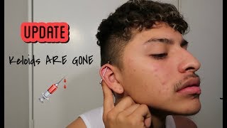 INFECTED INDUSTRIAL PIERCING UPDATE [upl. by Stargell]