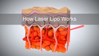 How Laser Lipo Works to Release Fat and Reduce Cellulite [upl. by Maleki911]