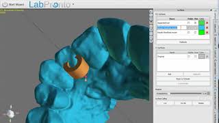 Single Implant Surgical Guide design in BSB Version 459 [upl. by Yurt848]