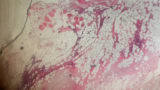 36 الورم ذو الخلايا البلاسمية والنقيوم المتعدد Plasmacytoma and multiple myeloma bone marrow [upl. by Adnohsirk]