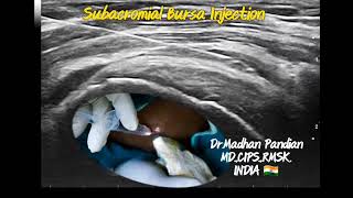 Subacromial bursa injection [upl. by Pirali508]