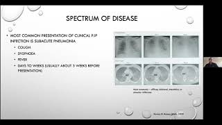 Pneumocystis jirovecii pneumonia  Current Issues in its Management [upl. by Weidner]