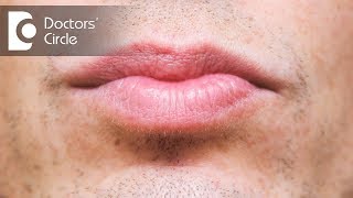 What causes discoloration below lip amp its management  Dr Sachith Abraham [upl. by Leizo]