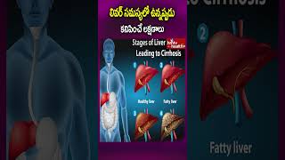 లివర్ సమస్యలో ఉన్నప్పుడు కనిపించే లక్షణాలుshorts liversymptoms liverdamage livertreatment [upl. by Motteo]