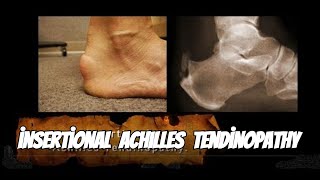 Why Achilles Tendinopathy Happens and How to Fix It [upl. by Nyberg51]