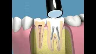 Tutti i passaggi della terapia canalare e della capsula dentale [upl. by Cly]