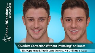 Overbite Correction No Braces or Invisalign® No Surgery in 8Days [upl. by Richers]