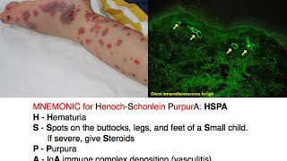 HenochSchonlein Purpura HSP Mnemonic [upl. by Harts]