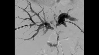 Percutaneous Transhepatic Cholangiography and Drainage PTCD [upl. by Sibley]