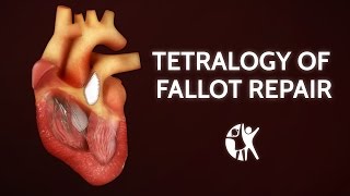 Tetralogy of Fallot Repair  Cincinnati Childrens [upl. by Aivle174]