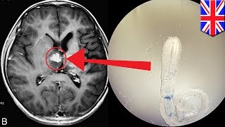 An investigation of Michael Mosleys tapeworms  Infested Living with Parasites  BBC Four [upl. by Assiron]