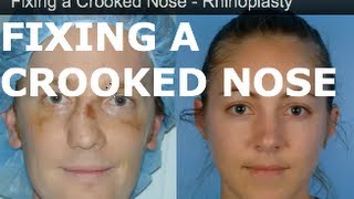 Fixed a Crooked Nose – Rhinoplasty in San Francisco – Dr David Kim [upl. by Acinnod498]