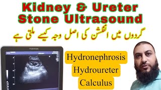 Kidney stone  ureter stone  Hydronephrosis  Hydroureter  Dr Qazi Fahim Shezad [upl. by Anaela710]