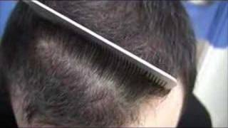 UK Hair Transplant Call 07578164162 [upl. by Yelha]