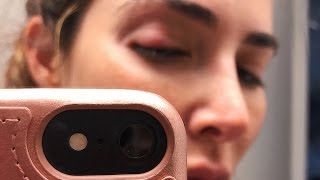 Eye Gland Problem Turned into Painful Chalazion [upl. by Kahn]