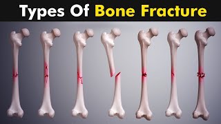 Breaking Down Femur Fractures  What You Need to Know [upl. by Frederik]