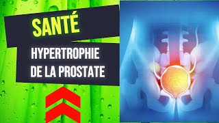 LHypertrophie Bénigne de la Prostate [upl. by Luaped]