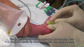 Paediatric Anaesthetics Chapter 7  Long saphenous IV neonate 1 [upl. by Eilujna]