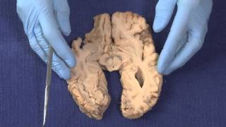 Basal Ganglia Neuroanatomy Video Lab  Brain Dissections [upl. by Anitnerolf]