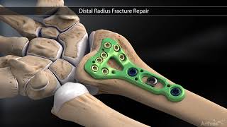 Distal Radius Fracture Repair [upl. by Eerrahs]