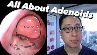 Adenoids and Adenoidectomy what are they when do we remove them what is the surgery like [upl. by Llennej765]