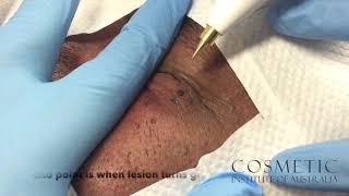 dermatosis papulosa nigra removal with radio frequency [upl. by Burny206]