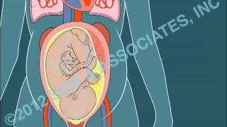 Amniotic Fluid Embolism AFE [upl. by Bathsheeb641]