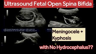 Ultrasound Fetal Spina Bifida with Meningocele and Kyphosis  what are Risk Factors [upl. by Ris]