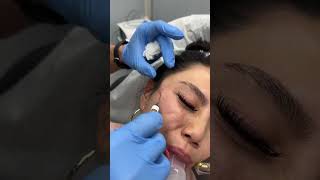 Under Eyes amp Temple Filler Treatments by Dr TJ Tsay  Ageless MD [upl. by Barbur]