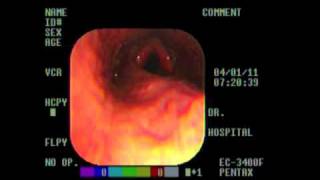 Epiglottic Entrapment with ulcer m4v [upl. by Leddy]