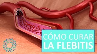 FLEBITIS Qué es y CÓMO CURARLA [upl. by Jameson]