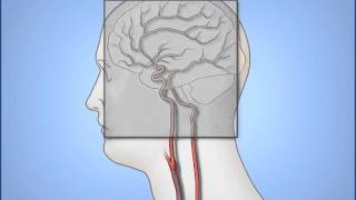 Diagnostic Cerebral Angiography [upl. by Anikal]