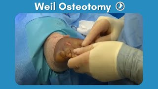 Weil Osteotomy Performed by Dr Paul Steinke [upl. by Bower]