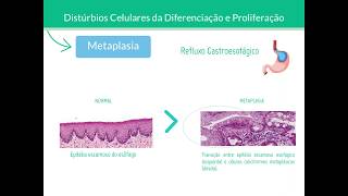 Metaplasia e Displasia  Patologia [upl. by Onder630]