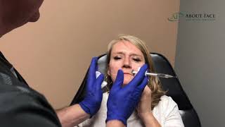 Juvederm Voluma Treatment Video [upl. by Cleveland]