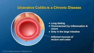 What is Ulcerative Colitis [upl. by Conlen]