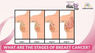 What are the stages of breast cancer [upl. by Millian]