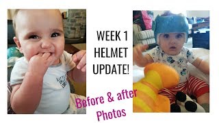 Plagiocephaly Helmet update  WEEK 1 Flat Head Syndrome Helmet Before and after photos [upl. by Haidabez]