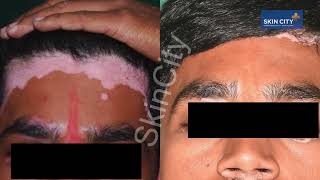 Safe amp Effective Vitiligo Laser Treatment  Dr Niteen Dhepe  SkinCity [upl. by Carlee]