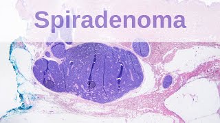 Eccrine Spiradenoma  Pathology mini tutorial [upl. by Nohsav305]