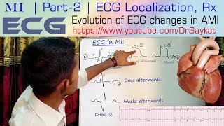 MI  Part 2  ECG Localization amp Treatment of Myocardial Infarction  Dr Saykat [upl. by Oyek]