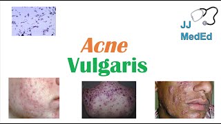 Acne Vulgaris  Causes Pathogenesis Influencing Factors Diagnosis Treatment and Complications [upl. by Verdha231]